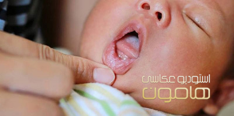 برفک دهان نوزاد چیست؟