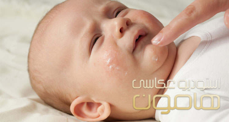 علت جوش‌های ریز صورت و بدن نوزاد