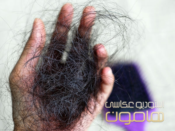 علت ریزش مو بعد از زایمان
