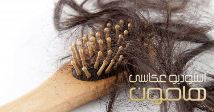 علت ریزش مو بعد از زایمان