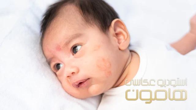 علت آلرژی فصلی پوستی در کودکان