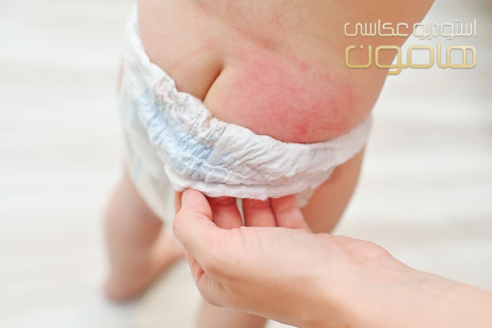 علائم حساسیت نوزاد به پوشک