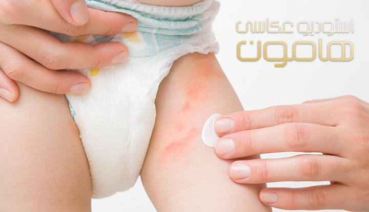 علائم حساسیت نوزاد به پوشک