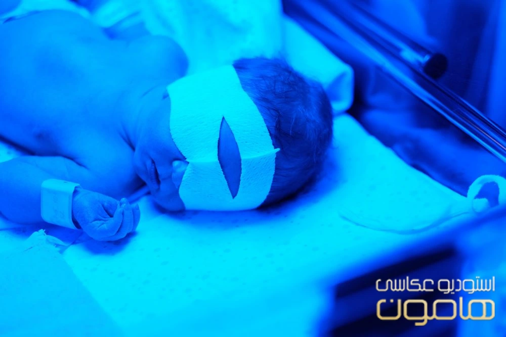علت زردی نوزاد و روش های پیشگیری از آن